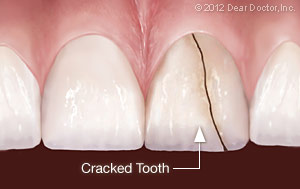 Severe crack on front of tooth