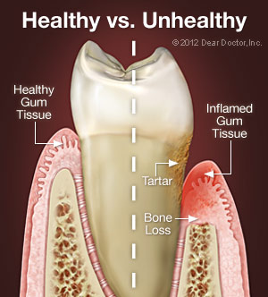 Comparison of health gum tissue and inflamed gum tissue