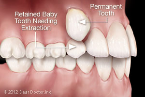 Baby tooth needing extraction alongside permanent tooth
