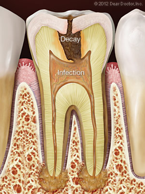 Tooth with decay and infection