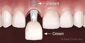 Dental implant insertion with crown 