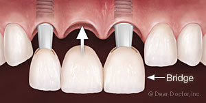 three unit dental bridge insertion