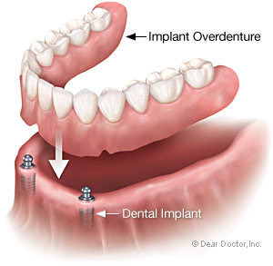 Implant overdenture supported by dental implant
